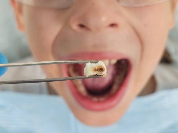 Best Emergency Tooth Extraction in Attica, IN